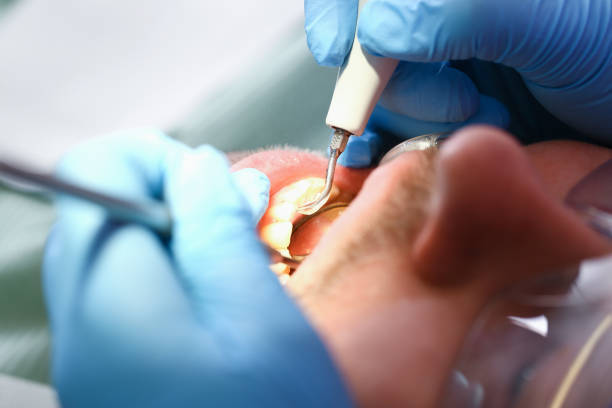 Best Emergency Root Canal Treatment in Wellford, SC