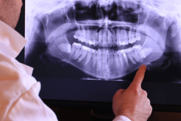 Best Emergency Dentist for Lost Fillings or Crowns in Wellford, SC